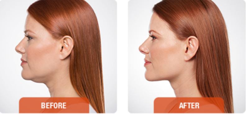 kybella before and after